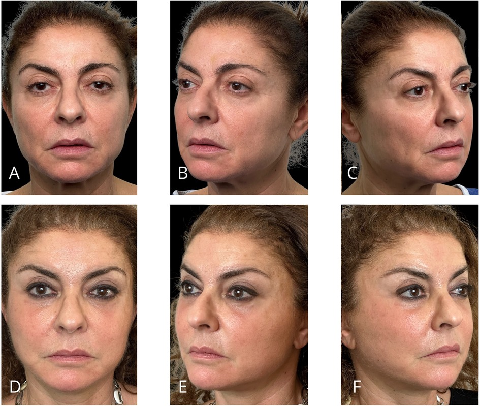 Six images of the same woman with two different expressions are shown. Images A, B, and C display a neutral expression from front and side angles. Images D, E, and F show the woman with makeup and a slight smile, also from front and side angles.