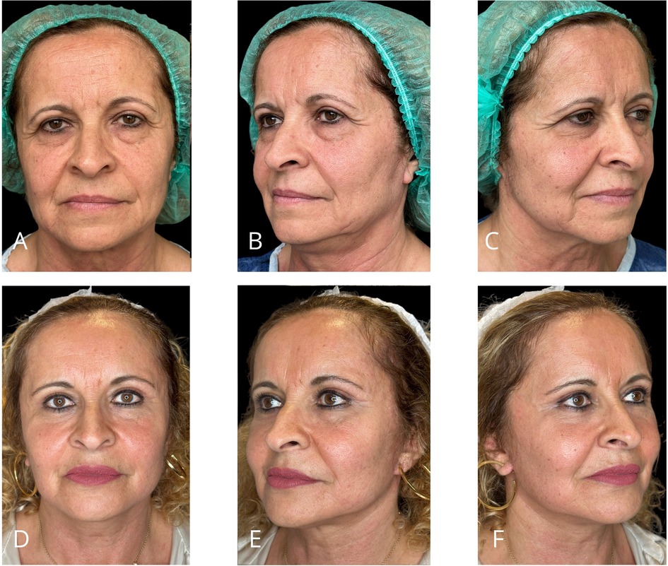Six-panel comparison of a woman's face before and after a cosmetic procedure. Panels A, B, and C show front and side views before the procedure, with a medical cap. Panels D, E, and F show similar views after the procedure, with visible enhancements in skin texture and appearance, and hair styled differently.