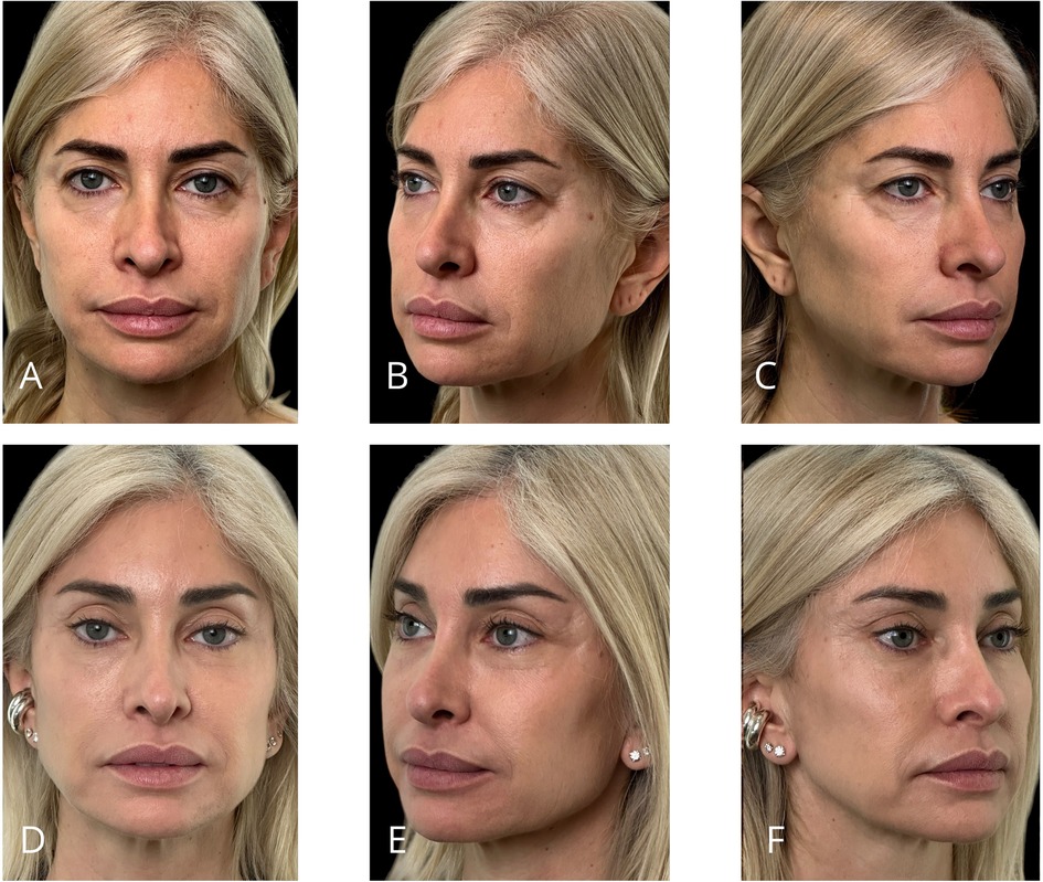 Six photos of a person with blonde hair are displayed. Photos A, B, and C show front and side profiles with no visible makeup or jewelry. Photos D, E, and F show the same angles, but the person is wearing makeup and earrings. Each row compares the same angle before and after makeup.