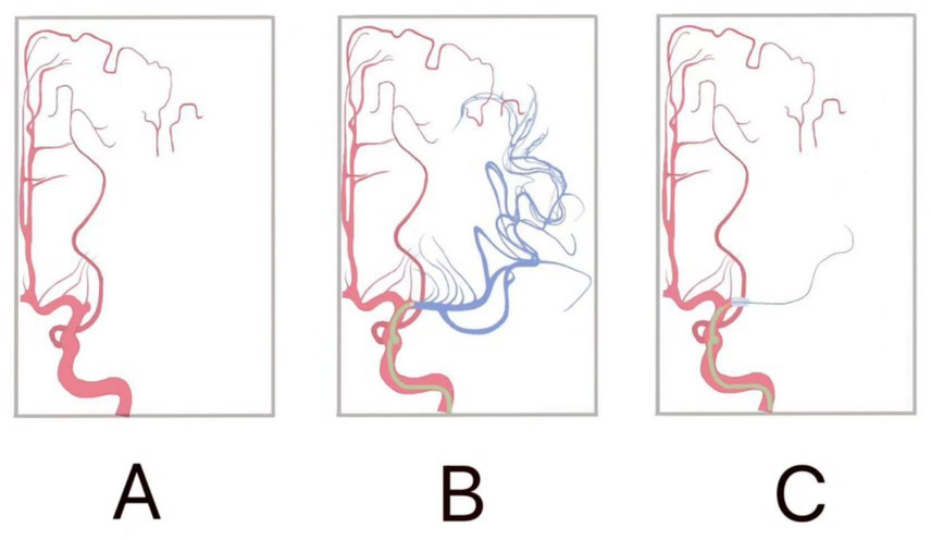 Three panels labeled A, B, and C depict simplified diagrams of cranial blood vessels. Panel A shows the vessels in red without additional details. Panel B highlights additional blue vessels branching out. Panel C shows a simplified vessel structure similar to A, without the blue branches from B.