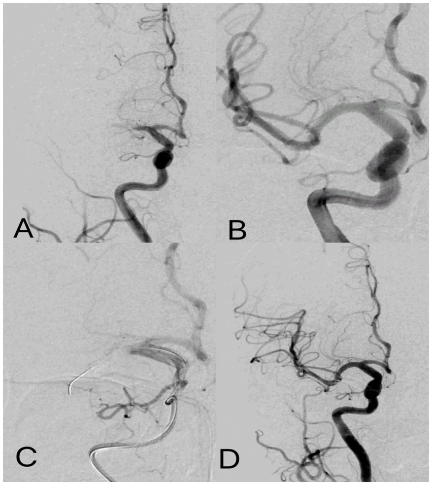 Angiographic images labeled A, B, C, and D, showing different views of cerebral arteries. Image A and B depict aneurysms, with distinct bulging. Image C shows a surgical instrument likely used for intervention. Image D shows the arteries post-procedure, with improved blood flow and reduced bulging.