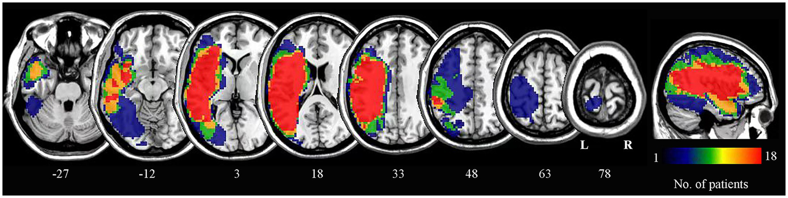 Brain MRI scans showing multiple transverse sections with color overlays indicating patient data. Colors range from blue to red, representing a scale from one to eighteen patients. Numerical labels at the bottom indicate section positions, and a color bar on the right provides a legend.