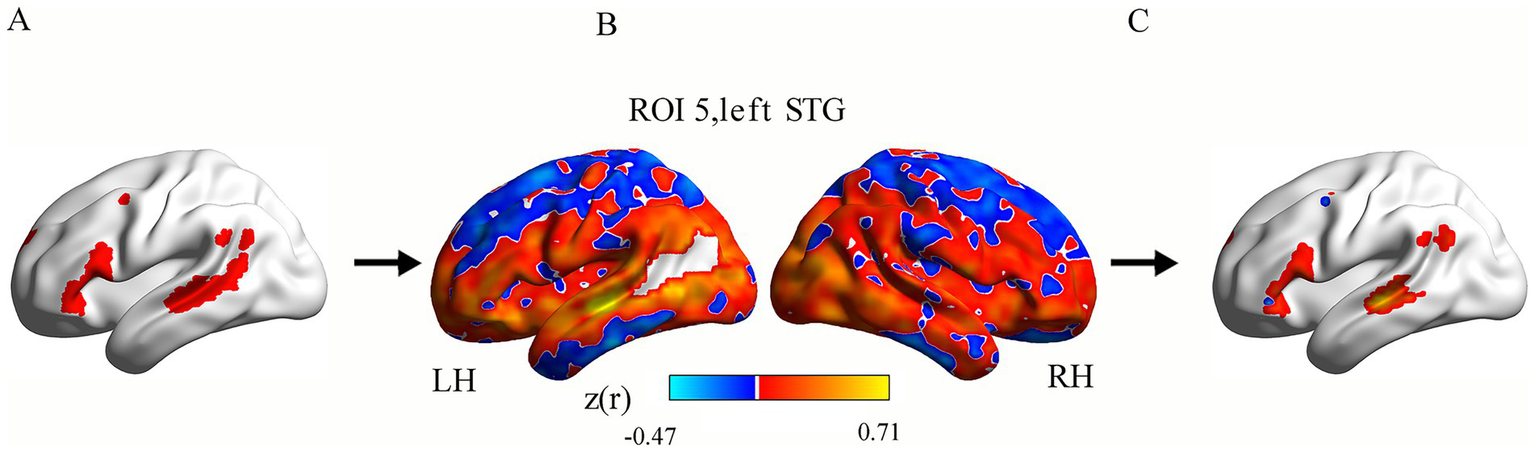 Three 3D brain models labeled A, B, and C. A and C depict white brain surfaces with red highlighted regions. B shows the left hemisphere (LH) and right hemisphere (RH) with a color gradient from blue to red, indicating different z(r) values from -0.47 to 0.71. ROI 5, left STG is noted.
