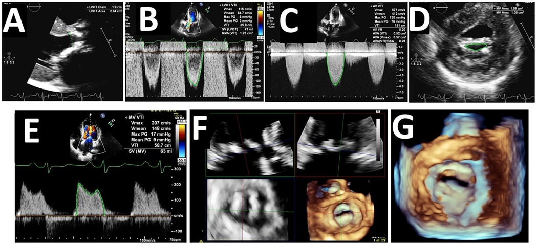 Composite image showing echocardiographic measurements and views. Panel A features LVOT diameter. Panel B and C display Doppler waveforms with respective VTI, Vmax, and mean PG values noted. Panel D shows mitral valve area. Panel E illustrates another Doppler waveform. Panel F includes two-dimensional echocardiogram images. Panel G presents a 3D reconstruction of a cardiac structure.