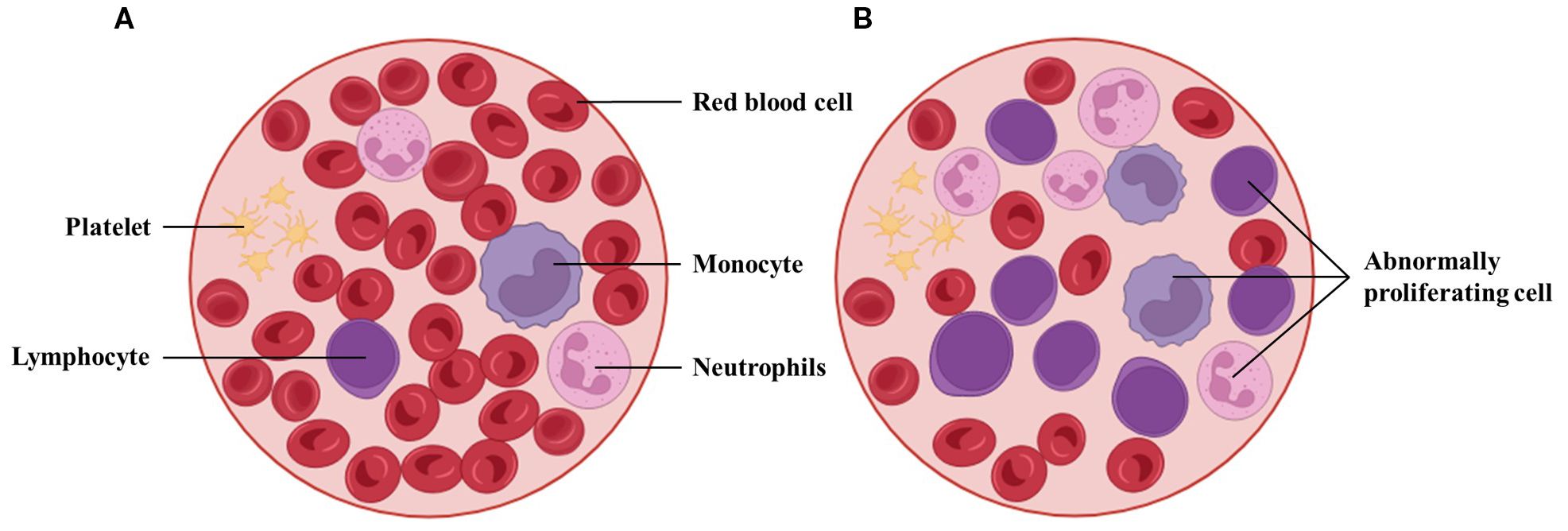 Diagram showing two panels labeled A and B, depicting cross-sections of blood. Panel A shows healthy blood with red blood cells, lymphocytes, monocytes, neutrophils, and platelets. Panel B shows similar elements but includes abnormally proliferating cells, indicating a pathological condition.