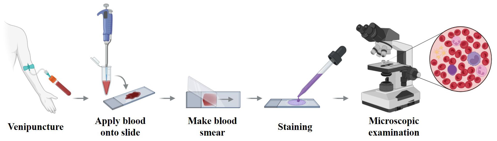 Illustration of the blood smear process, starting with venipuncture. Blood is applied onto a slide, spread to make a smear, stained with a substance, and examined under a microscope, revealing detailed blood cells.