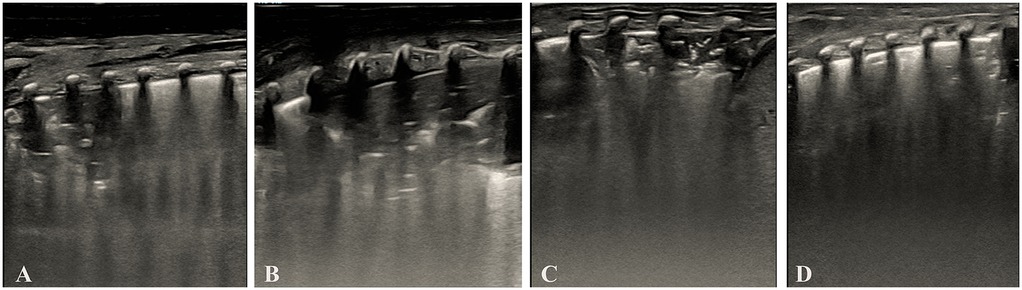 Series of lung ultrasound (LUS) images showing the sequential changes in an infant with neonatal respiratory distress syndrome (NRDS) undergoing surfactant therapy. Panel A displays initial findings of pulmonary consolidation, bronchial inflation sign, absent A-lines, and irregular pleural line. Panel B shows persistent consolidation after the first dose of surfactant. Panel C shows reduced consolidation after the second dose. Panel D shows complete resolution of consolidation, normal pleural line, and visible A-lines after the third dose.
