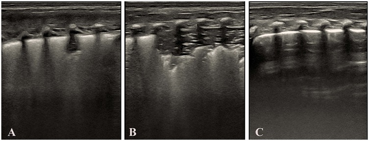 Series of lung ultrasound (LUS) images demonstrating the development and response to surfactant treatment in a transient tachypnea of the newborn (TTN) infant with pulmonary consolidation. Panel A shows initial alveolar-interstitial syndrome (AIS) features including blurred pleural line without consolidation. Panel B shows progression to pulmonary consolidation, bronchial inflation sign, absent A-lines, and irregular pleural line. Panel C shows complete resolution of consolidation, restored normal pleural line, and reappearance of A-lines following surfactant administration.