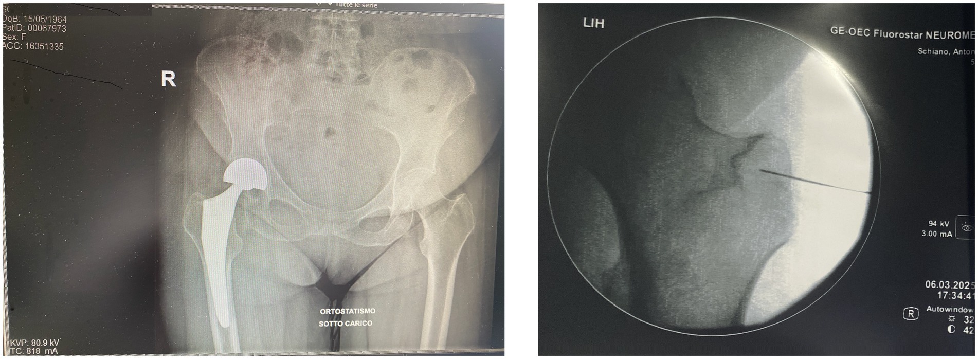 Two X-ray images are shown. The first image displays a frontal view of a right hip, showing the joint and surrounding bones. The second image features a fluoroscopic view of the same hip, with a needle or similar object inserted near the joint, indicating an intervention or procedure. Both images contain technical data and identification details on the edges.