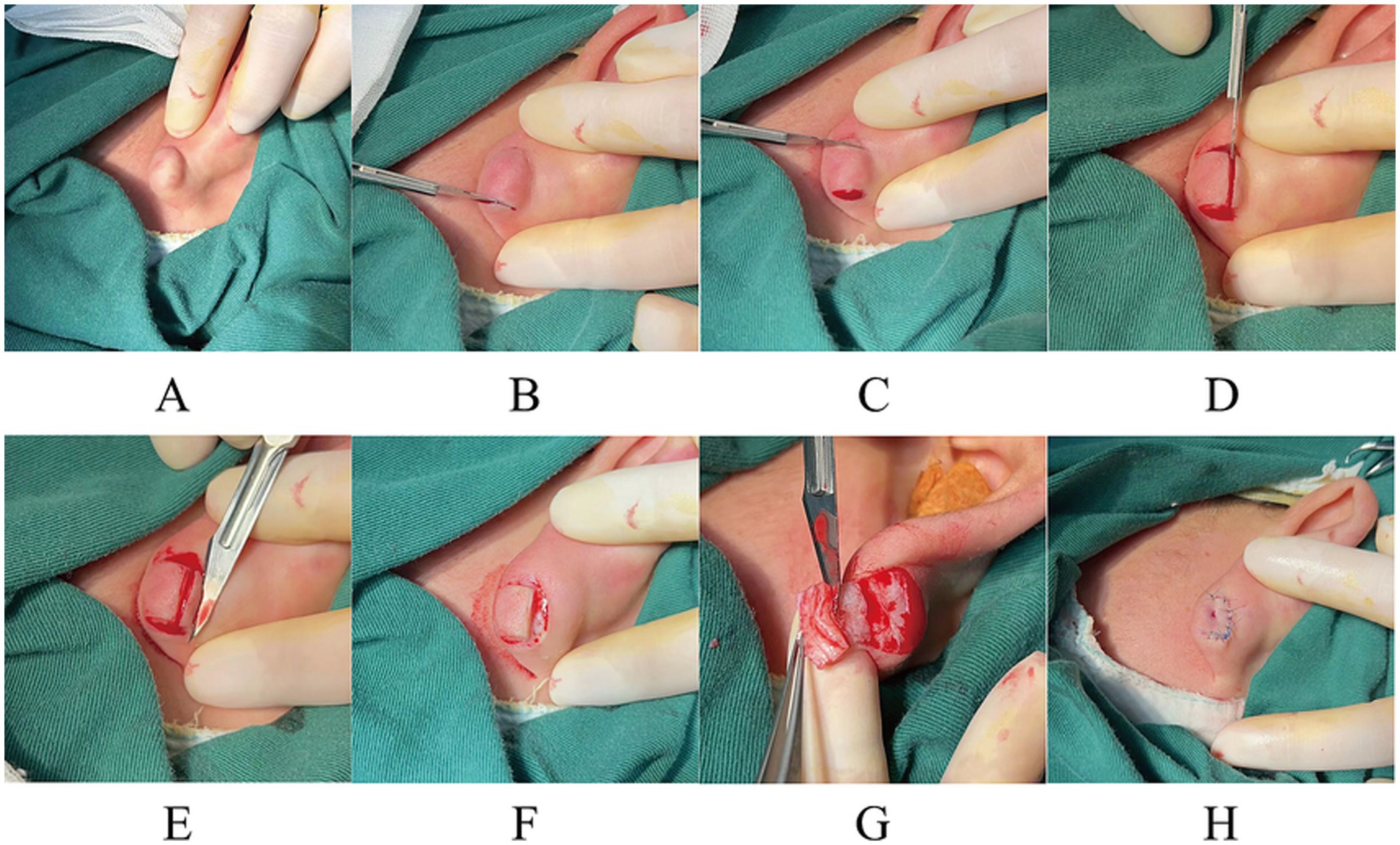 A series of eight surgical procedure images labeled A to H. A: A protrusion under the skin. B: A small incision being made. C and D: The incision widened, exposing tissue. E: Further incision with surgical tools. F and G: Removal of tissue. H: The incision site stitched closed.