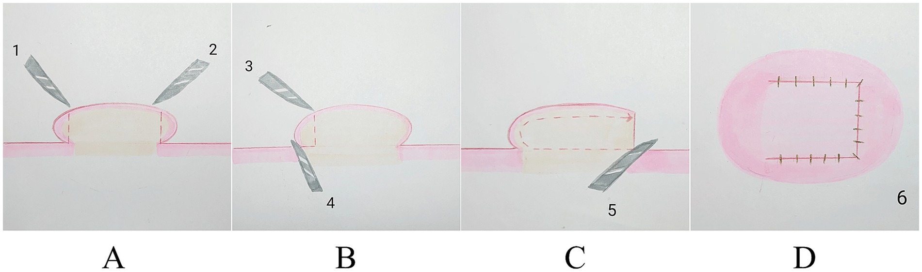 Diagram showing a four-step surgical procedure. Panel A: Two incisions labeled