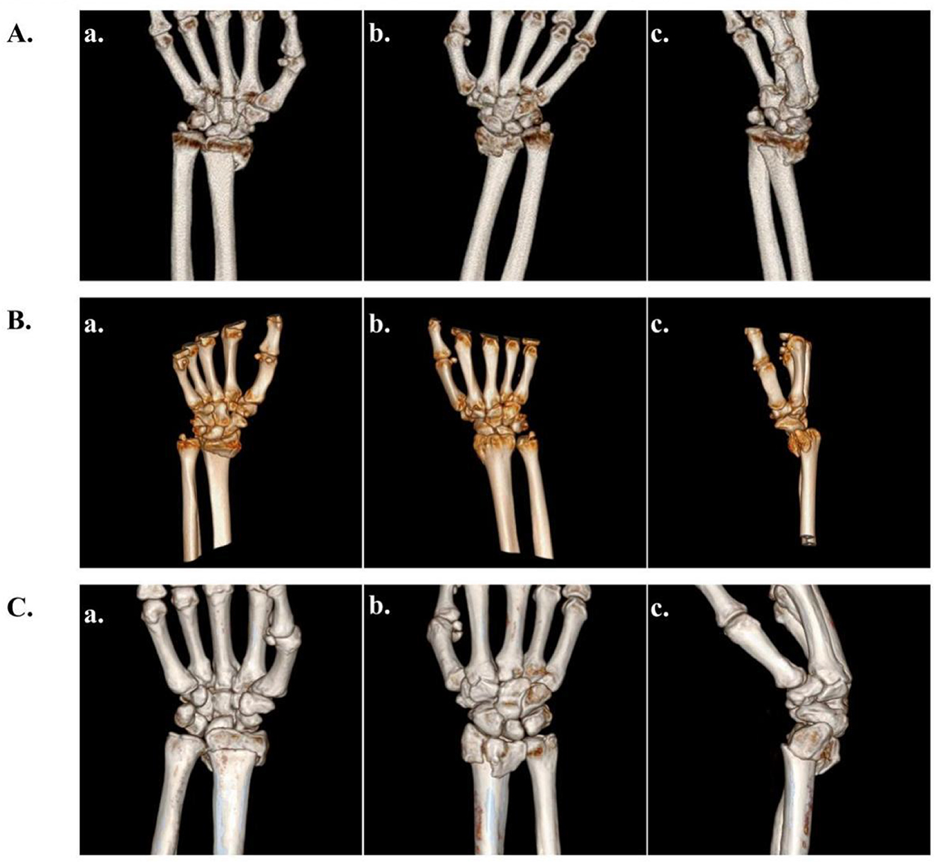 Three rows of bone imaging labeled A, B, and C. Each row has three panels labeled a, b, and c. Row A shows dorsal views of wrist bones. Row B illustrates oblique and dorsal views of wrist bones. Row C displays dorsal and lateral views of wrist bones. Each panel presents different angles and positions of the bones against a black background.