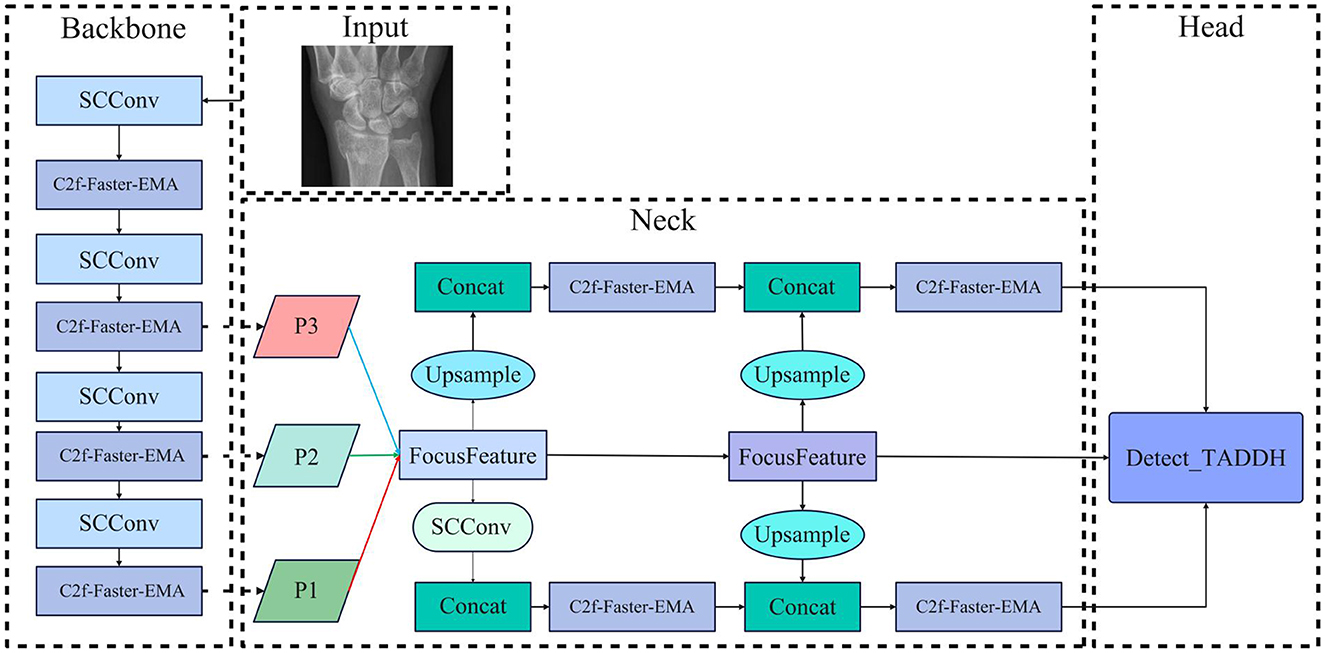 Flowchart illustrating a neural network architecture for detecting TADDH from an input radiograph. It features a backbone with alternating SCConv and C2f-Faster-EMA layers, a neck with focus feature, upsampling, and concatenation components, leading to the head which identifies the detection.
