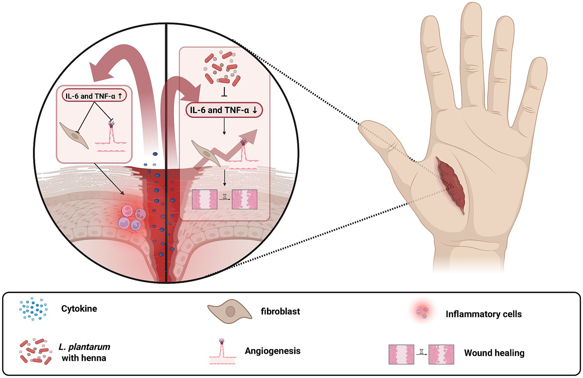 Illustration of wound healing on a hand, highlighting the roles of cytokines and inflammatory cells. A circular inset compares two conditions: one with increased IL-6 and TNF-alpha causing fibrosis, and another with L. plantarum and henna reducing these cytokines, promoting angiogenesis and improved healing. The legend explains symbols for cytokines, L. plantarum with henna, fibroblast, angiogenesis, inflammatory cells, and wound healing.