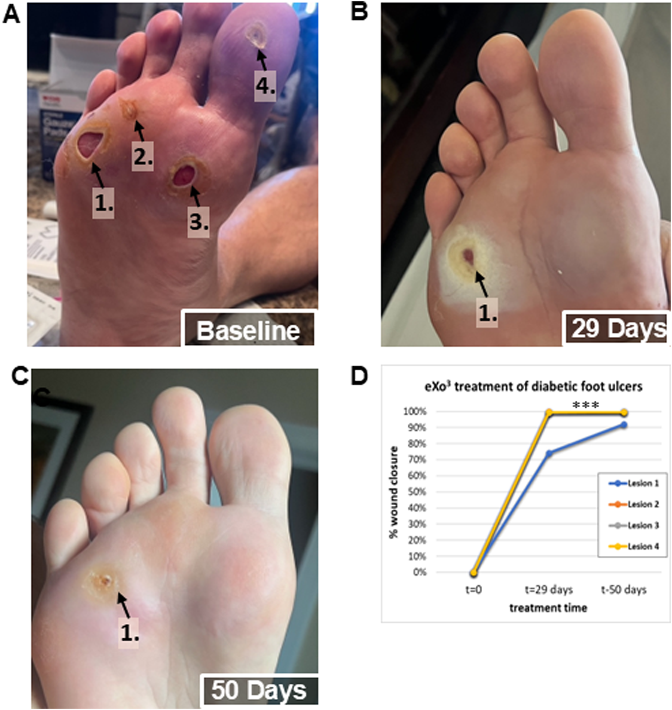 Images A, B, and C display the healing progression of diabetic foot ulcers at baseline, 29 days, and 50 days respectively, with each lesion marked. Image D is a line graph showing the percentage of wound closure over time for four lesions, indicating significant healing, especially at 29 and 50 days.