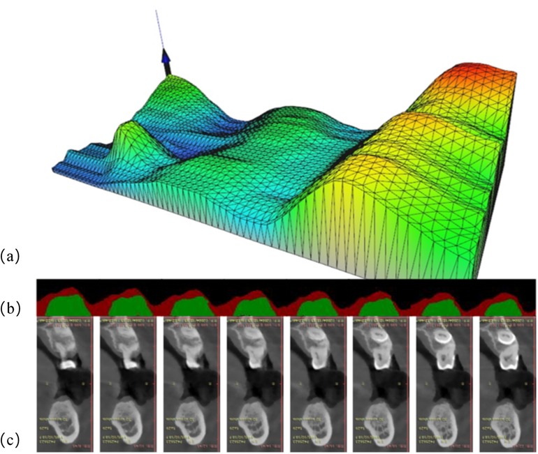(a) A 3D surface plot with triangular mesh, colored from blue to red, indicating varying elevations. (b) A top view image of the colored surface with green and red sections. (c) A series of black and white cross-sectional MRI images of teeth, showing different slices.