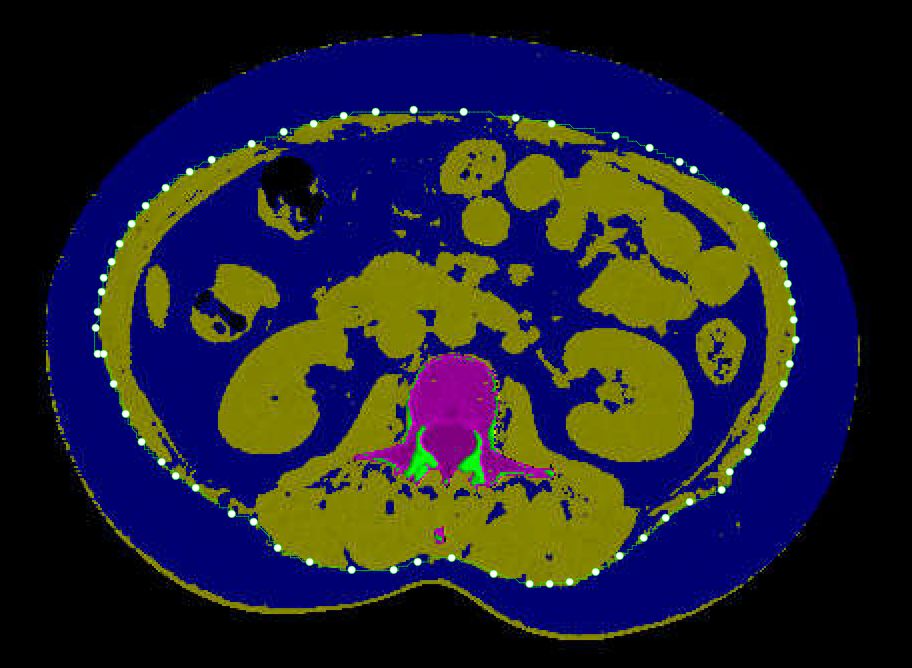 CT scan image of an abdomen with different regions highlighted in various colors. A central area is marked in pink, likely representing a specific organ or structure, while surrounding areas are indicated in blue, green, and black.