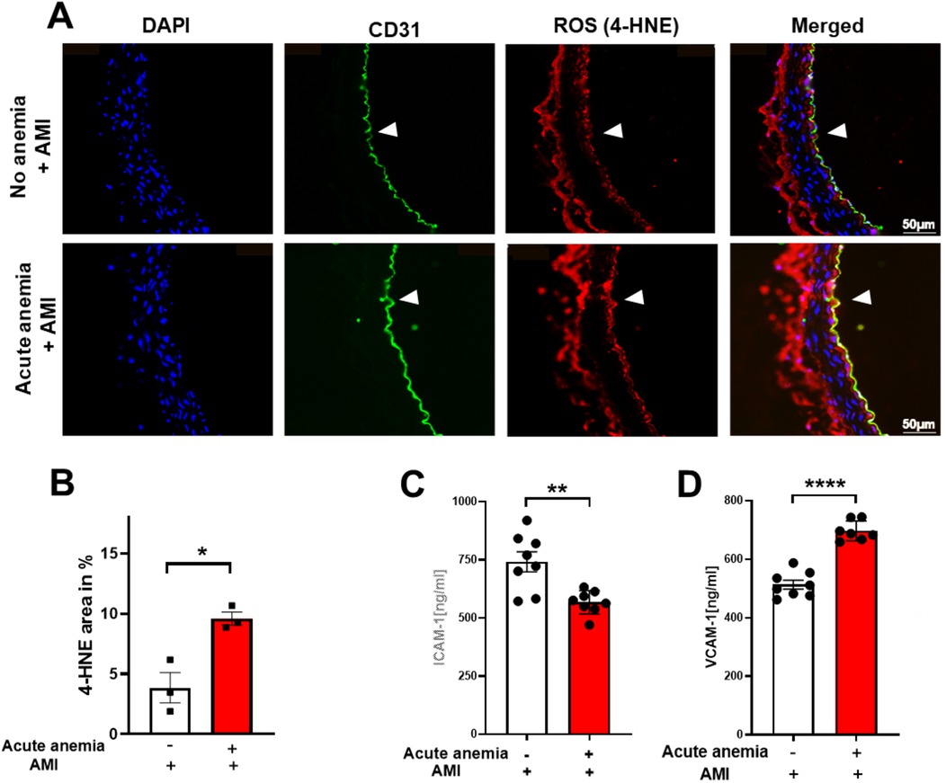 Panel A shows immunofluorescence images comparing no anemia and acute anemia with acute myocardial infarction (AMI). DAPI stains nuclei blue, CD31 is green, and ROS (4-HNE) is red with a merged view. Panels B, C, and D are bar graphs. Panel B shows a significant increase in 4-HNE area in acute anemia, indicated by an asterisk. Panel C displays elevated ICAM-1 levels, marked by two asterisks, and Panel D shows VCAM-1 levels, highlighted with four asterisks. Arrows indicate points of interest in the images.