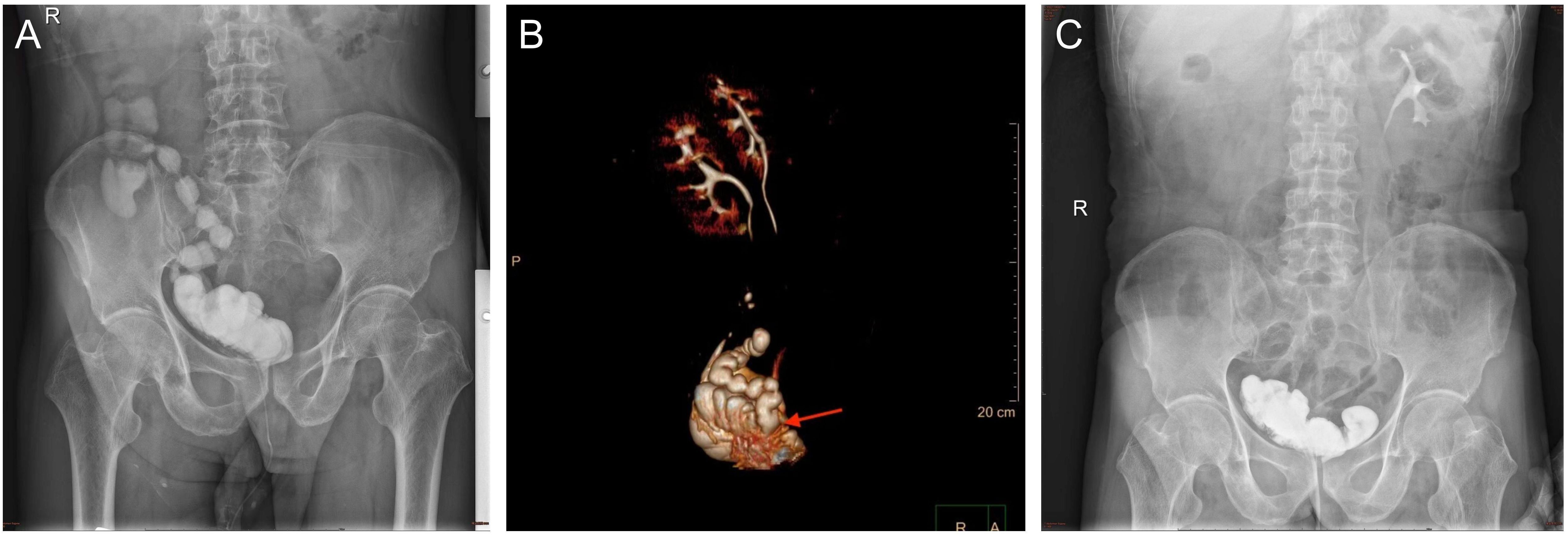 Abdominal imaging showing three panels: Panel A and B display X-ray images of the abdomen with visible skeletal structures and some internal details. The middle panel is a CT image highlighting the abdominal organs, with a red arrow pointing to a specific area.