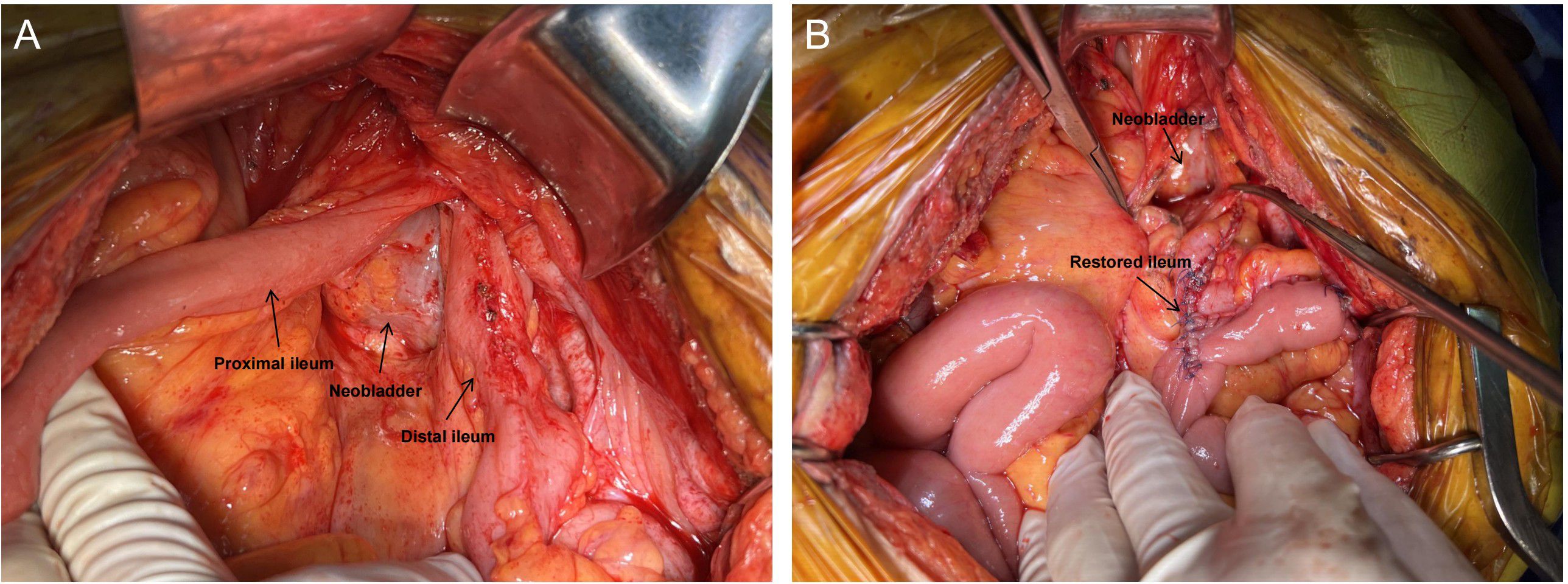 Surgical images showing two stages of a procedure involving the ileum. Panel A depicts the proximal and distal ileum, labeled alongside a neobladder. Panel B shows the neobladder and restored ileum. Surgical instruments and gloved hands are visible, indicating active operation.