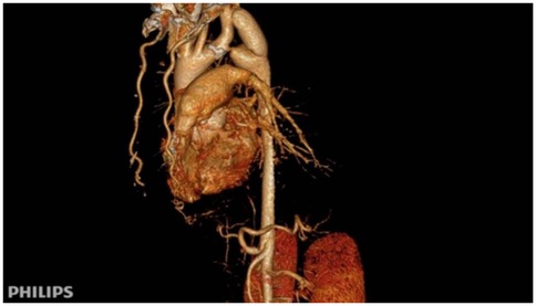 Three-dimensional medical scan showing detailed anatomy of the human thoracic region, including the heart, major blood vessels, and parts of the pulmonary structures, against a black background. \