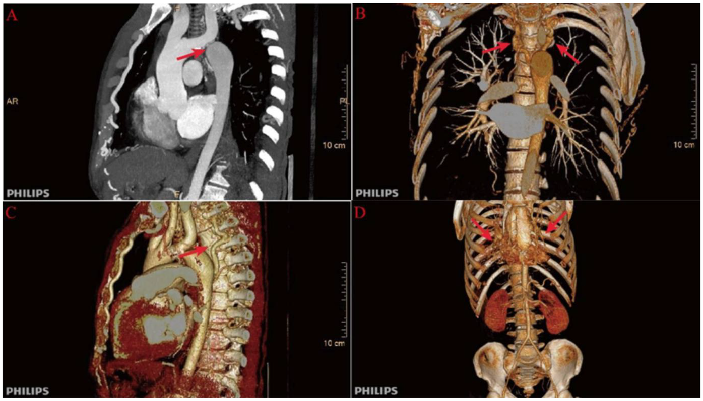 CT imaging series with four panels labeled A, B, C, and D. Each panel shows a different view of the thoracic spine and vascular structures, highlighting an abnormal condition with red arrows. Panels display both sagittal and coronal views, illustrating arteries and surrounding skeletal anatomy.