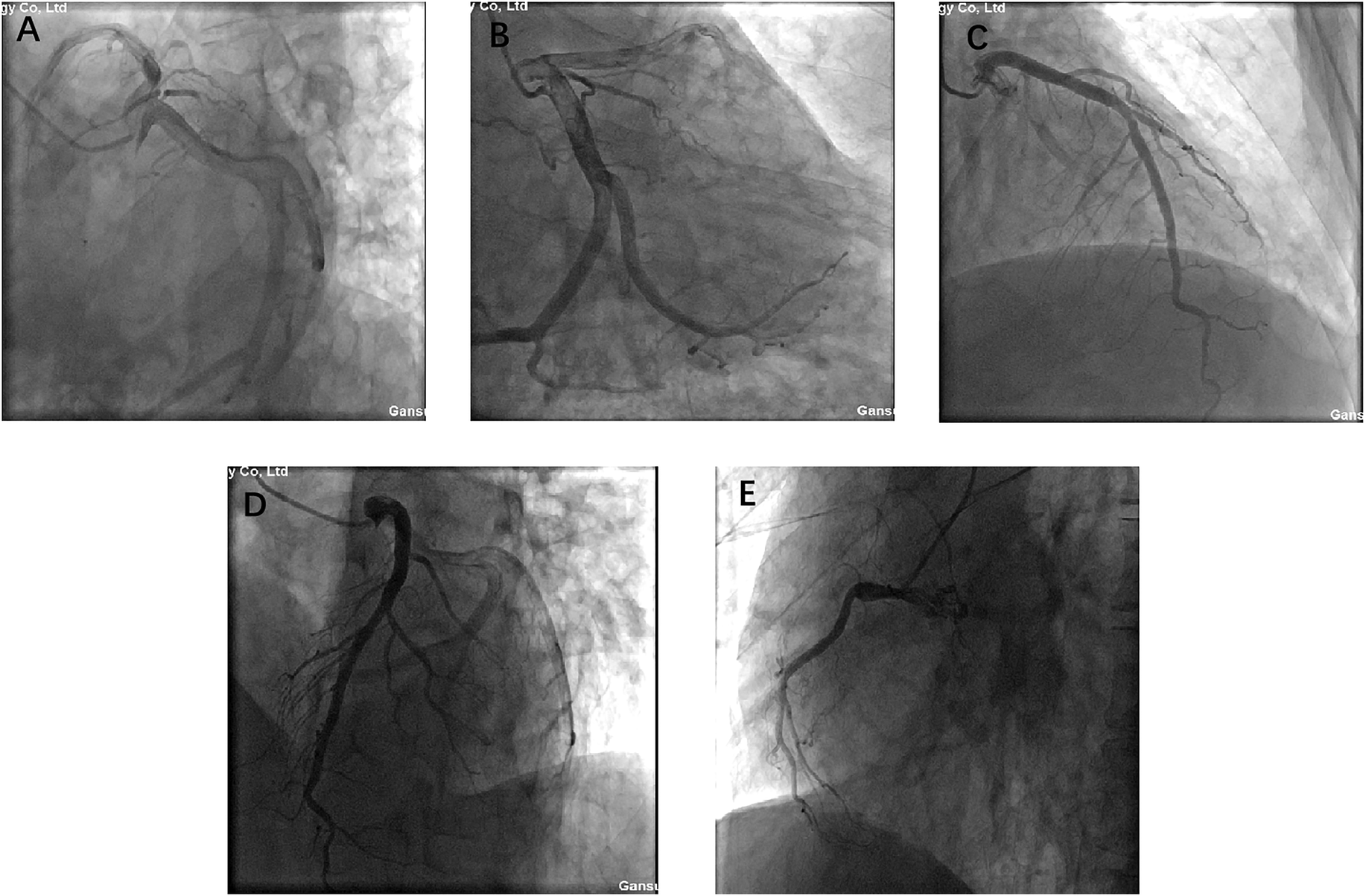 A series of six grayscale coronary angiographic images labeled A to F. Each panel shows different views of coronary arteries with contrast dye highlighting the vascular structures, revealing varying degrees of vessel visibility and patterns.