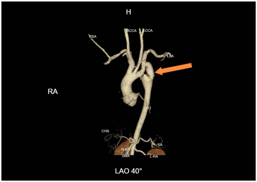 Computer-generated image of the human arterial system highlighting various branches. Labels indicate arteries, such as RSA, RCCA, and LSA. An orange arrow points to the descending aorta, labeled AO. Orientation noted as LAO 40 degrees.