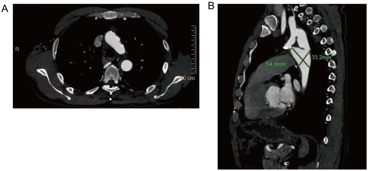 CT scan images showing two views. Image A is an axial view of the thorax with various anatomical structures visible. Image B is a sagittal view with measurements marked in green, showing dimensions of 54.0 millimeters and 33.2 millimeters near the chest area.