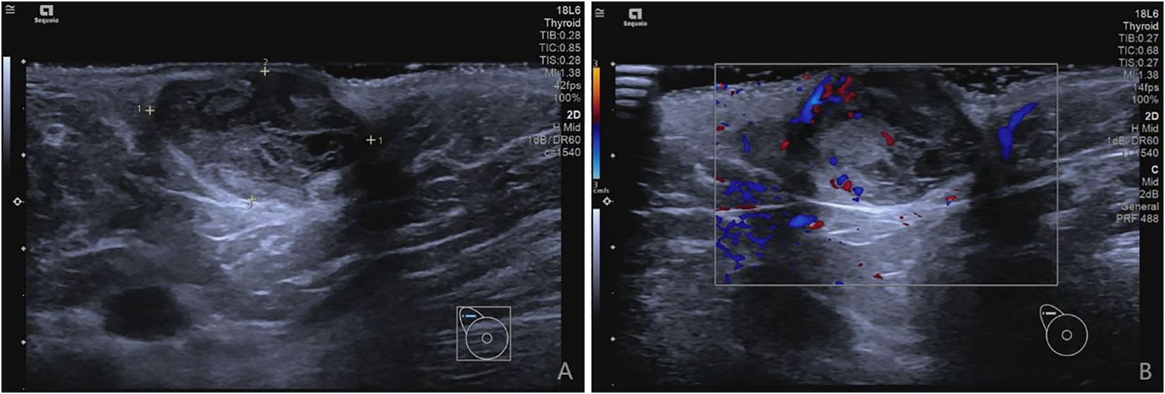 Ultrasound images of the thyroid. Image A shows a grayscale view with anatomical features marked by plus signs. Image B is a color Doppler ultrasound showing blood flow in red and blue, indicating direction and velocity.