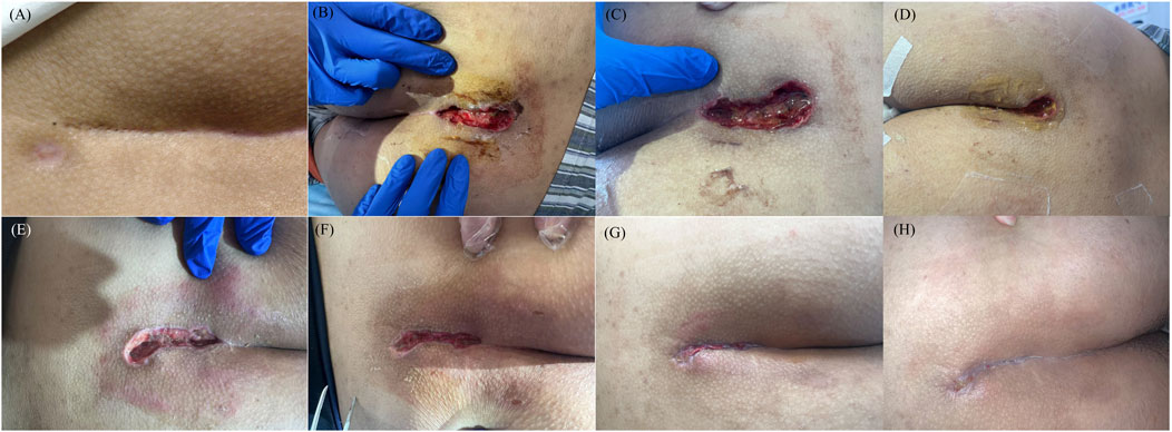 A series of images showing the progression of wound healing. (A) A small purplish mark on the skin. (B-D) Wounds with varying degrees of redness and tissue exposure, while gloved hands manipulate the area. (E-F) Partially healed wounds with noticeable redness but reduced depth. (G-H) Significantly healed wounds with a small scar remaining.