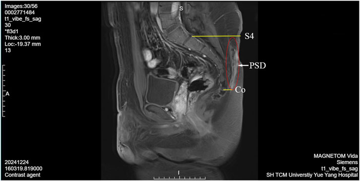 MRI scan showing a sagittal view with sections labeled S4, PSD, and Co. The annotations highlight specific areas within the spinal region. Acquired using MAGNETOM Vida at SH TCM University Yue Yang Hospital.