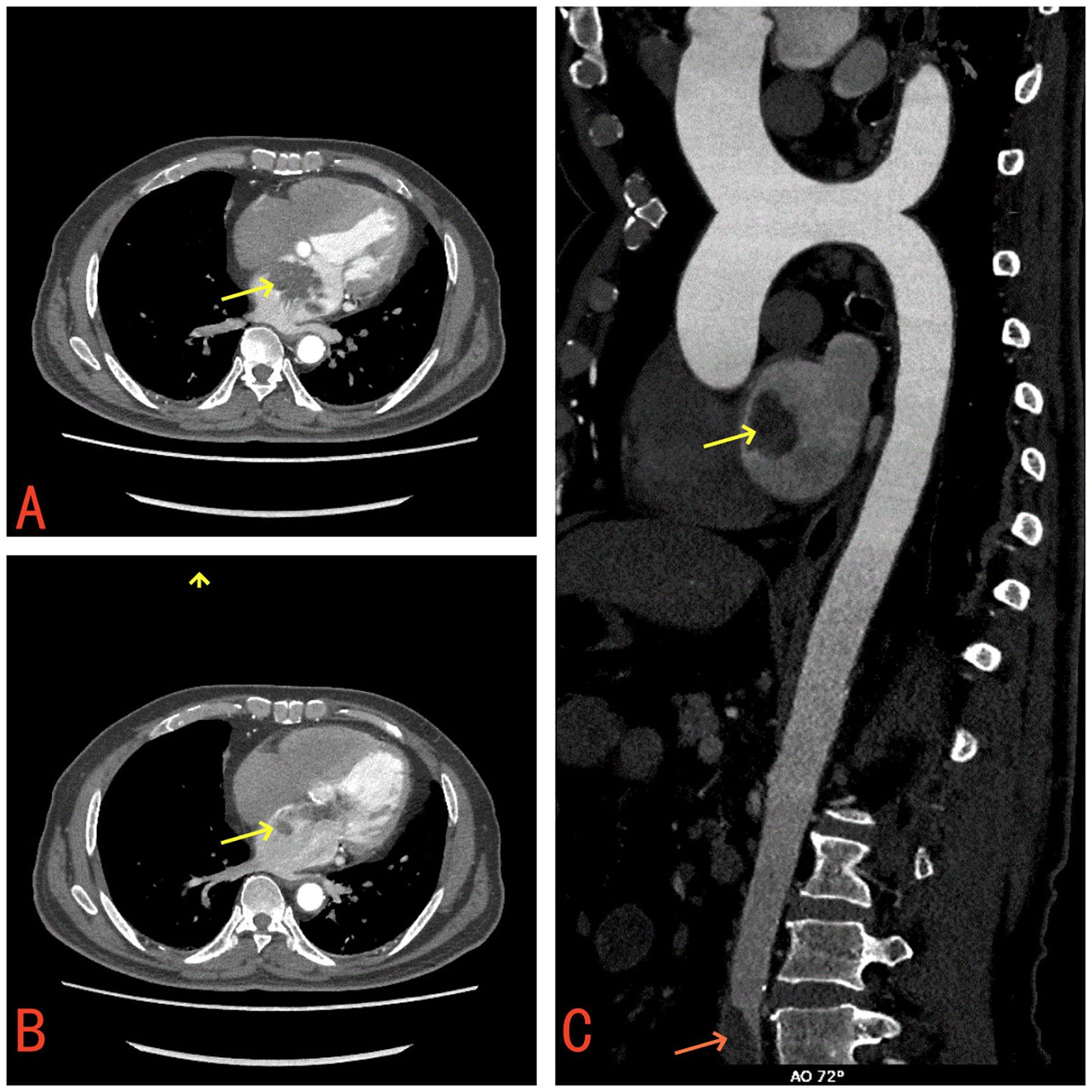 CT scans showing two axial views and one sagittal view. Image A and B are axial, highlighting a mass in the left atrium with a yellow arrow. Image C is a sagittal view of the aorta with a yellow arrow pointing to a thrombus at the bifurcation of the abdominal aorta and bilateral common iliac arteries.