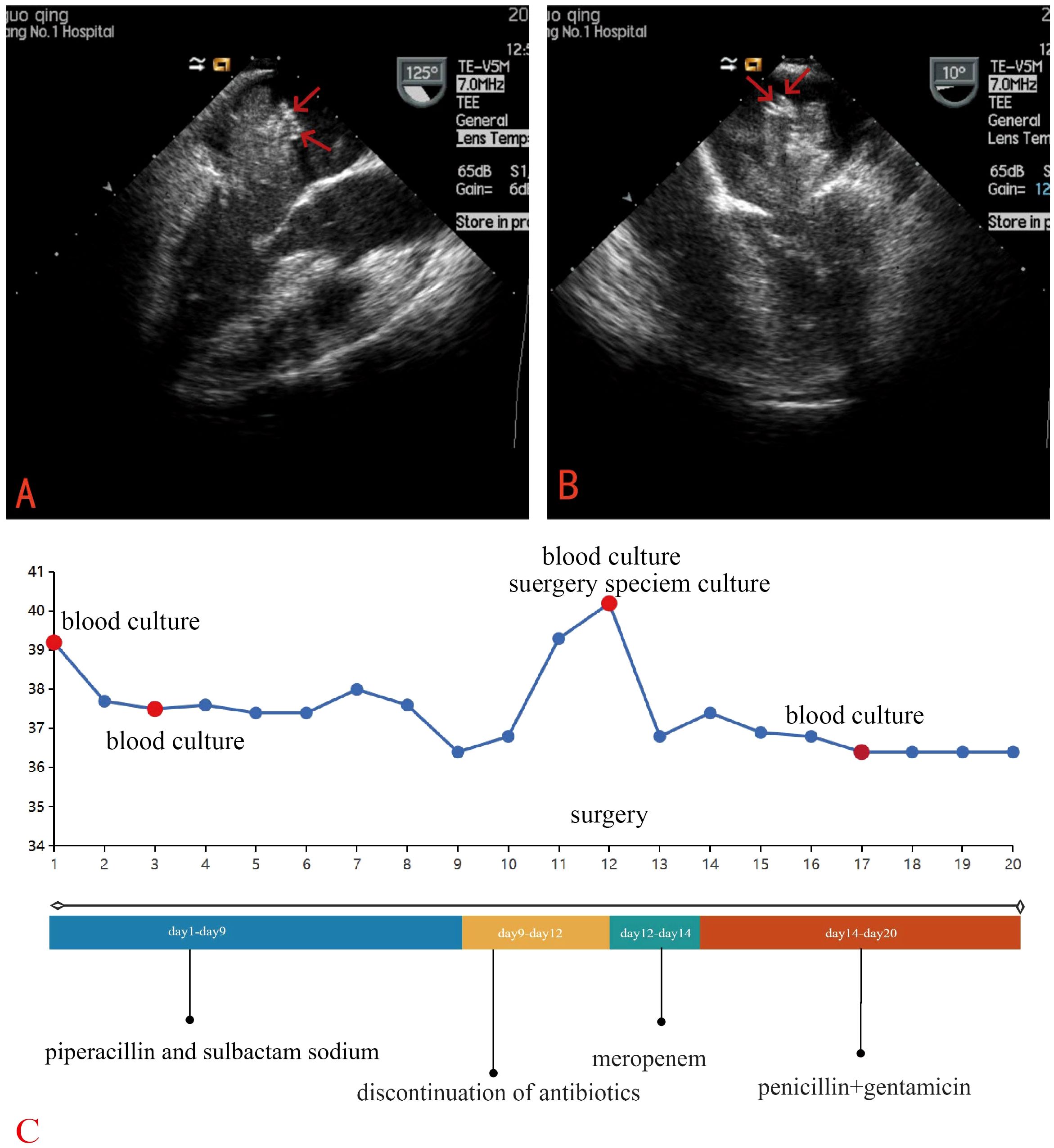Panel A shows an ultrasound image with arrows pointing to an elongated, irregular mass originating from the fossa ovalis in the left atrium. Panel B displays a similar ultrasound image with long-axis view of the left ventricle. Panel C features a line graph depicting temperature changes over 20 days, correlating with antibiotic treatments and surgical interventions. Red dots mark significant events like blood cultures and surgery. The timeline below the graph outlines periods of different antibiotic regimens: piperacillin and sulbactam sodium, discontinuation, meropenem, and penicillin with gentamicin.