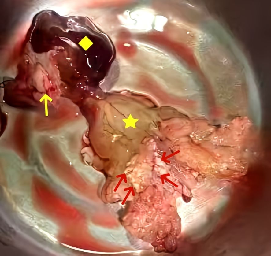 Surgical image showing a pedunculated, lobulated, dark-red, gelatinous mass. The tissue is irregular in shape and color, with reddish areas evident.