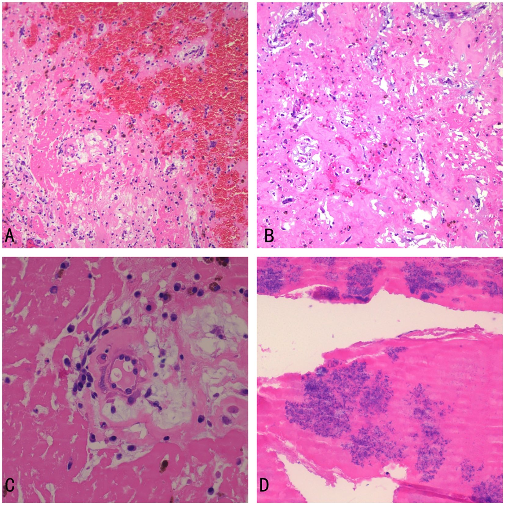 A composite image of four histological slides shows varied tissue structures. Panel A exhibits the myxoma with hemorrhages. Panel B shows spindle-shaped cells, and stellate cells scattered on the background of a myxomatous matrix . Panel C highlights myxoma under high magnification. Panel D displays bacterial colonies and fibrin on the surface of the myxoma under high magnification.