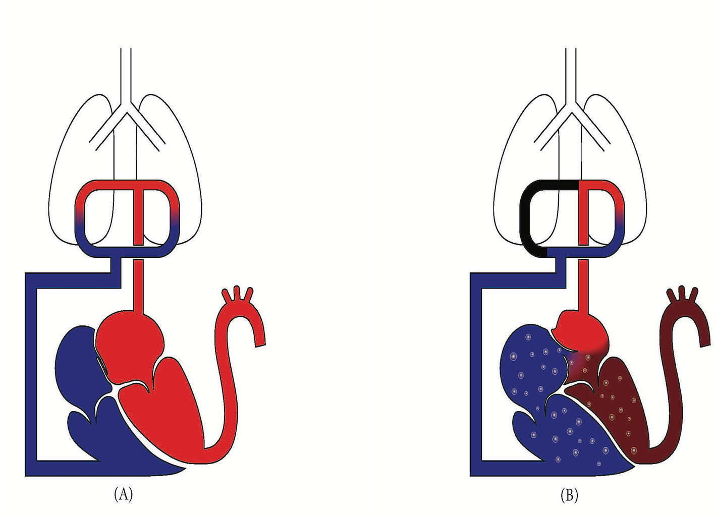 Diagram showing two heart-lung bypass machine configurations. Panel A illustrates a standard setup with red and blue pathways. Panel B depicts a variation with a black segment, suggesting altered circulation. Both panels include outlines of lungs and the heart, with arrows indicating direction of blood flow.
