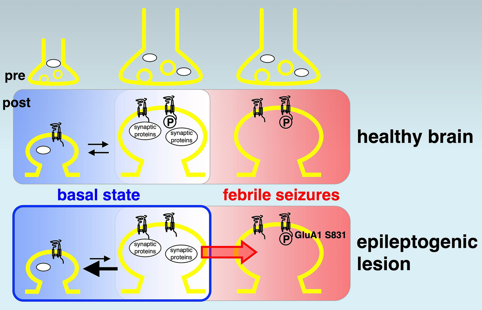 Diagram illustrating synaptic changes between a healthy brain and an epileptogenic lesion. The "healthy brain" section shows pre and post synaptic structures in basal state and febrile seizures, with synaptic protein phosphorylation depicted. In the "epileptogenic lesion" section, differences during febrile seizures are highlighted, specifically the phosphorylation of GluA1 S831.
