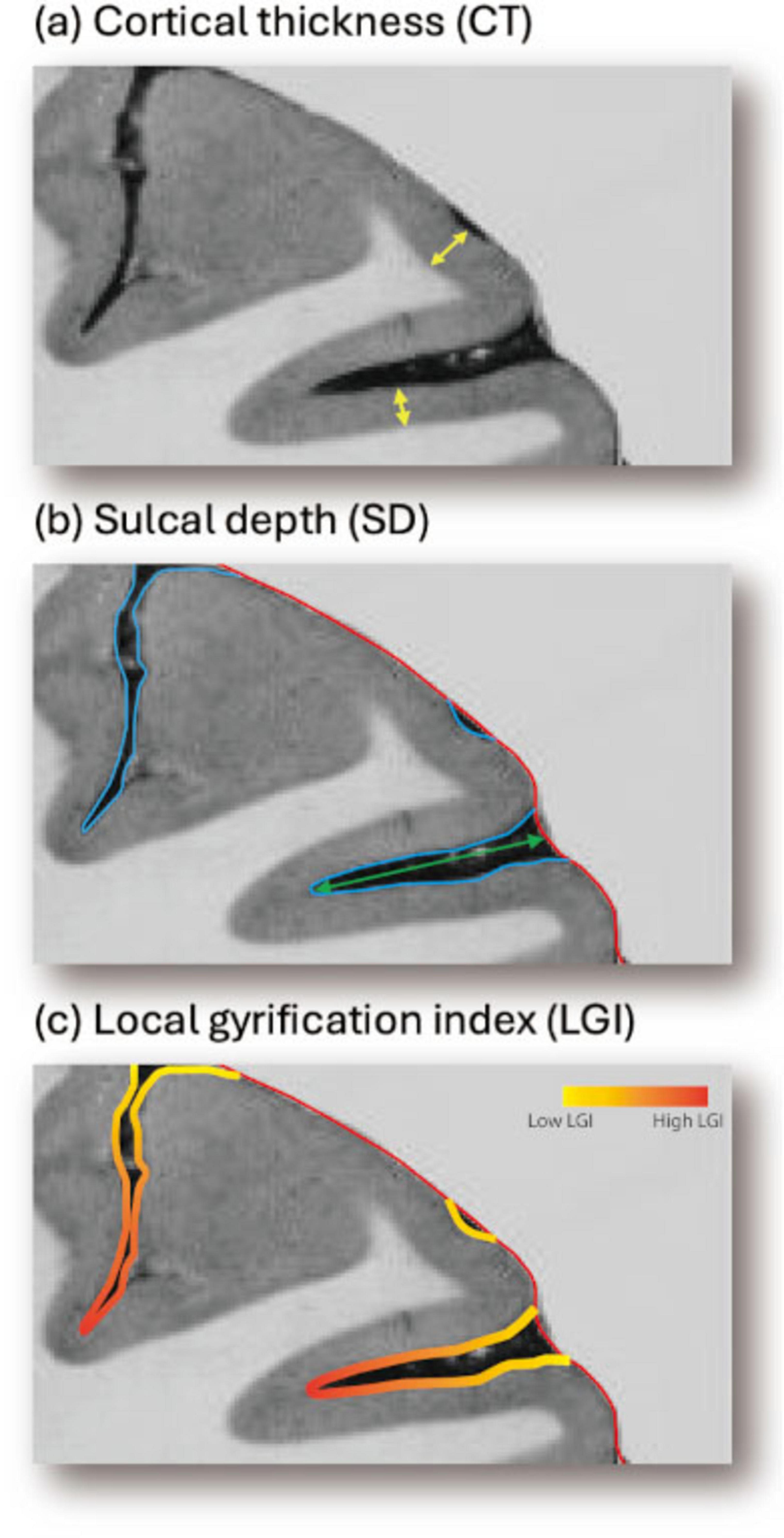 Cross-sectional illustrations of a brain showing three metrics. (a) Cortical thickness (CT) measured by yellow arrows. (b) Sulcal depth (SD) with blue lines indicating depth levels. (c) Local gyrification index (LGI) with a color gradient from yellow to red indicating low to high LGI.
