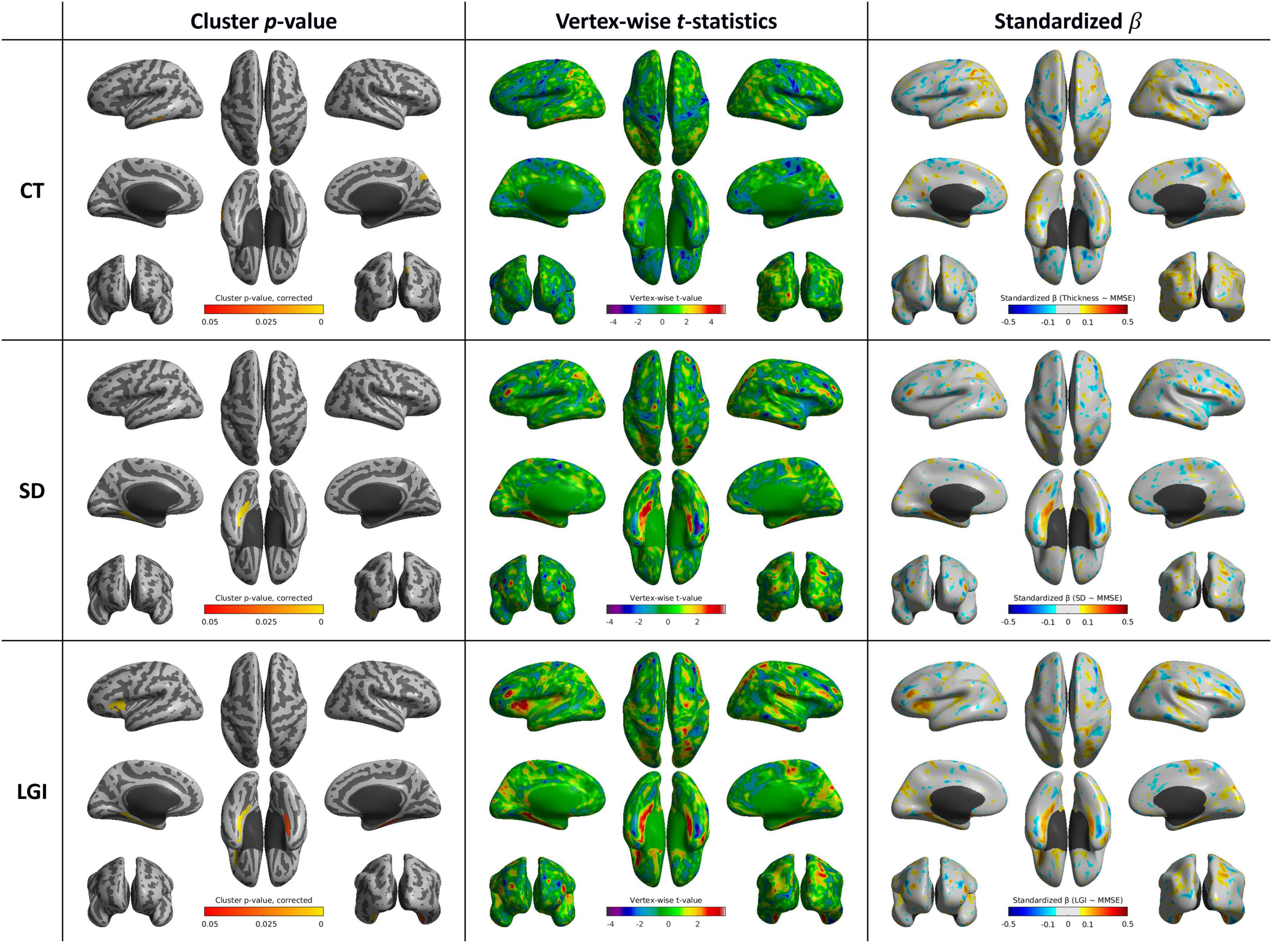 Brain imaging data comparing three measures: cortical thickness (CT), surface deformation (SD), and local gyrification index (LGI). Each measure is assessed through cluster p-values, vertex-wise t-statistics, and standardized beta values. The columns show top, side, and bottom brain views with color scales indicating data variations, such as purple to red for t-statistics, and blue to yellow for standardized beta values.