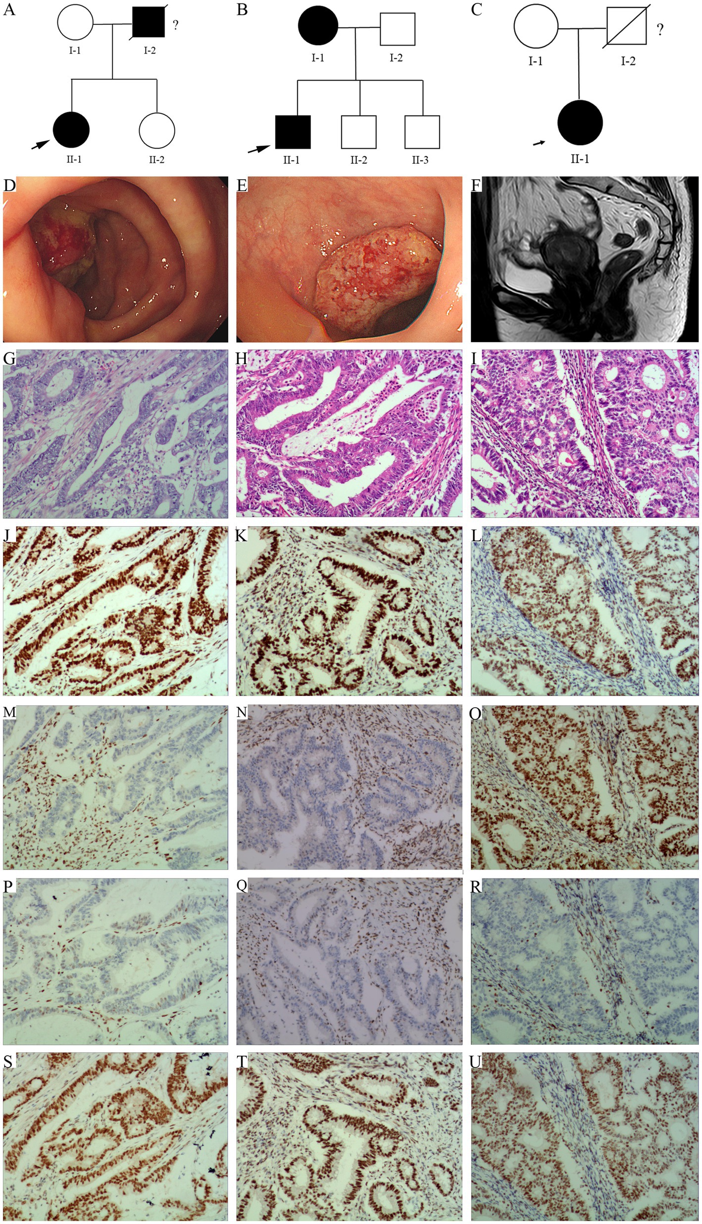 (A) to (C) Pedigree diagrams showing family histories with various genetic conditions. (D) and (E) Endoscopic images of polyps in the colon. (F) MRI scan of the pelvic region displaying abnormal growth. (G) to (I) Histological slides show different tissue structures stained for microscopic examination. (J) to (U) Stained tissue samples showing various levels of cellular detail and reactions, likely representing immunohistochemistry results.