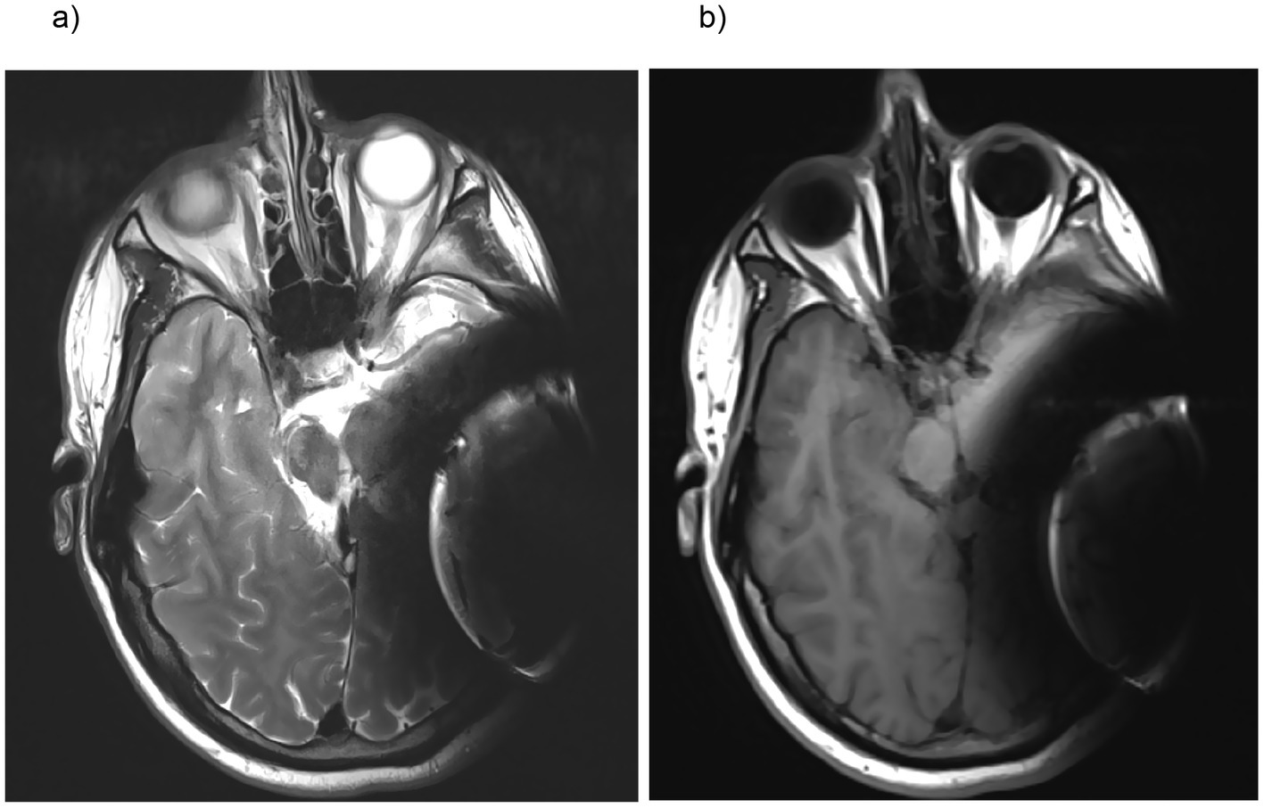 MRI scans showing two axial views of the brain with two different MRI sequences.