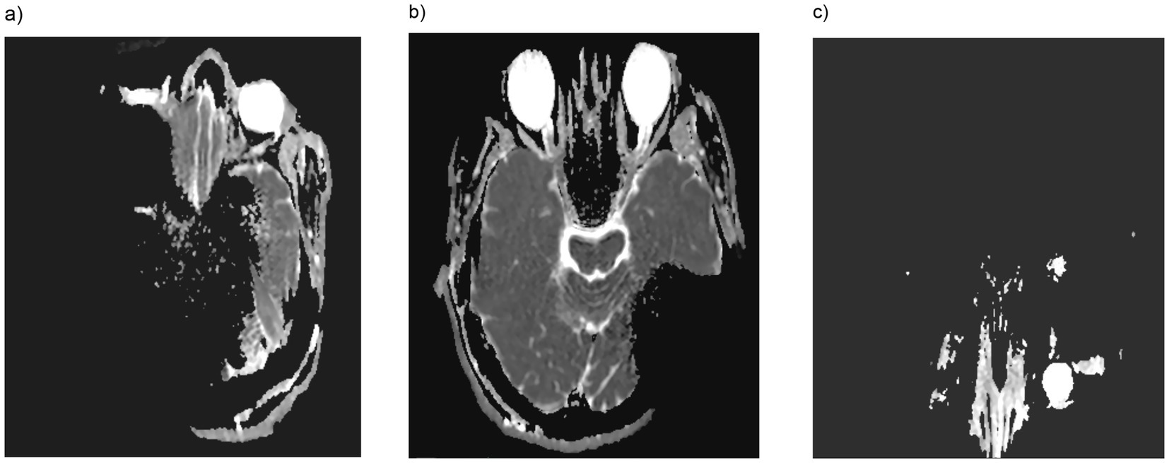 Three medical imaging scans are shown. Image (a) displays an axial CT scan of the head highlighting soft tissue structures. Image (b) is another CT scan with a focus on the cranial region's bone and tissue details. Image (c) presents a segmented view, possibly isolating specific areas within the cranial scan for analysis.