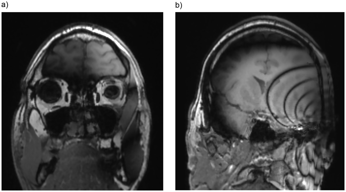 MRI scans of a human brain in coronal view showing the different artifact formations for different MRI sequences.