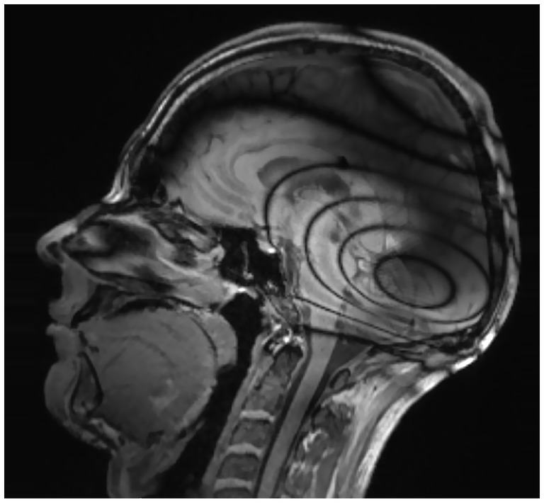 MRI scan of a human head in sagittal view showing the artifact formation.