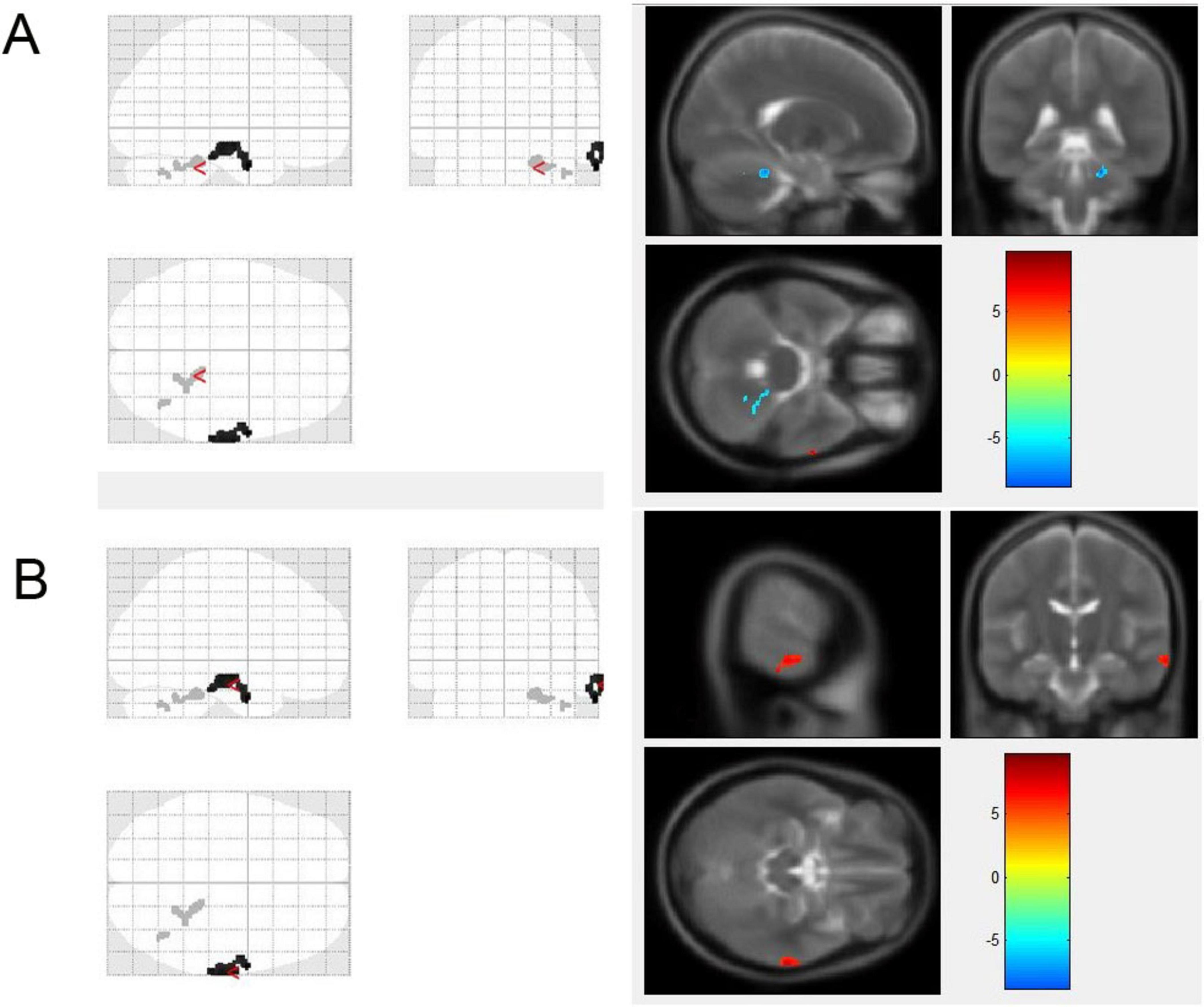 Brain imaging data showing two sets labeled A and B. Each set contains three diagrams on the left and three brain scans on the right. Colored areas in the brain scans correspond to a color scale indicating value ranges from negative five to positive five, with colors transitioning from blue to red. The diagrams on the left feature grid patterns with directional arrows and shaded areas, corresponding to regions highlighted in the brain scans.