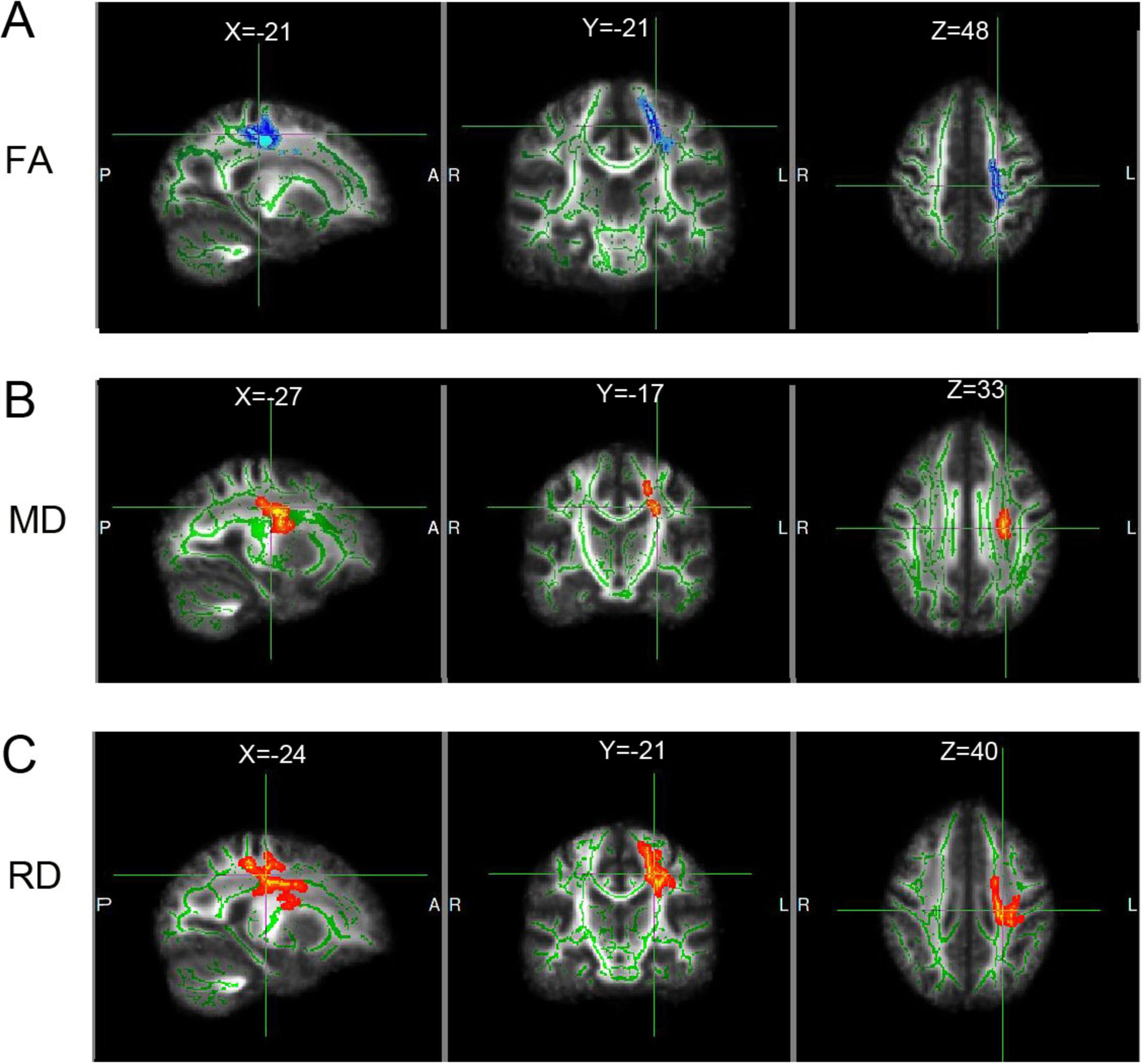 Brain imaging scans in three rows labeled A, B, and C, each with three panels showing different views (sagittal, coronal, axial). A shows FA with blue highlights at coordinates X=-21, Y=-21, Z=48. B shows MD with red highlights at X=27, Y=-17, Z=33. C shows RD with red highlights at X=-24, Y=-21, Z=40. Green outlines indicate brain structure.