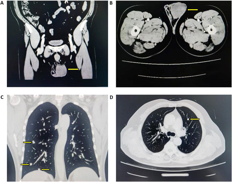 CT imaging findings of left testicular neoplasm and bilateral pulmonary nodules (A) Coronal view of left testicular mass-like slightly hyperdense focus with mild enhancement (B) Axial view of corresponding left testicular lesion (C) Coronal view of bilateral pulmonary nodules (D) Axial view of bilateral pulmonary nodule.
