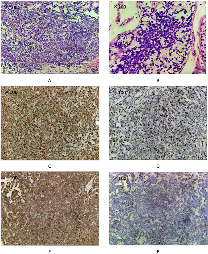 Pathology images and immunological staining outcomes of the testicular tumor (A) H&E magnification 100x. Microscopic features of spermatocitic tumor (B) H&E magnification 200x. Microscopic features of spermatocitic tumor (C) Spermatocytic tumor cells show cytoplasmic positivity with SALL4 (100x) (D) Ki-67 proliferation index was 60% (100x) (E) Spermatocytic tumor cells show strong membrane staining for CD117 (100x) (F) Spermatocytic tumor cells show negative for OCT3/4 (100x).