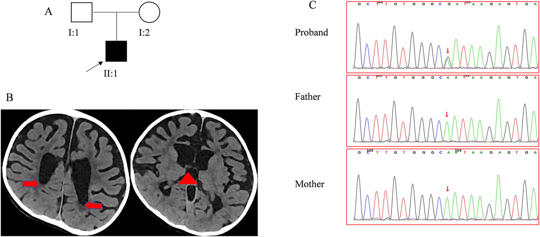 A composite image consists of three parts. Part A shows a pedigree diagram with symbols representing family members; the proband is indicated. Part B displays two axial brain CT scans highlighting abnormalities with red arrows and a triangle. Part C features three DNA chromatogram sequences for the proband, father, and mother, with red arrows pointing to specific nucleotide variations.